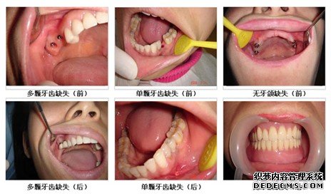 武汉爱齿尔口腔牙齿缺失